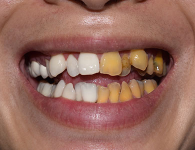Discolored or Stained Teeth