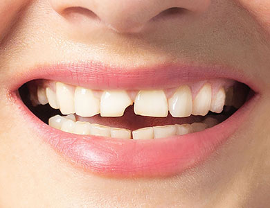 Chipped, Cracked, or Misaligned Teeth