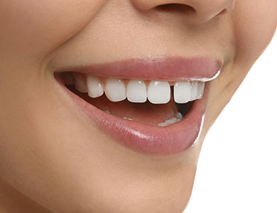 Gaps or Uneven Smile