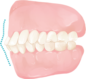 Protrucing Teeth