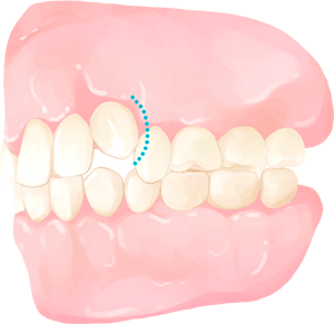 Crowded Teeth