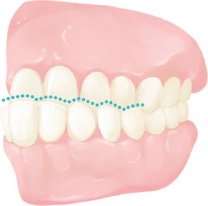 Underbite (Reverse Bite)