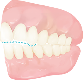 Open Bite